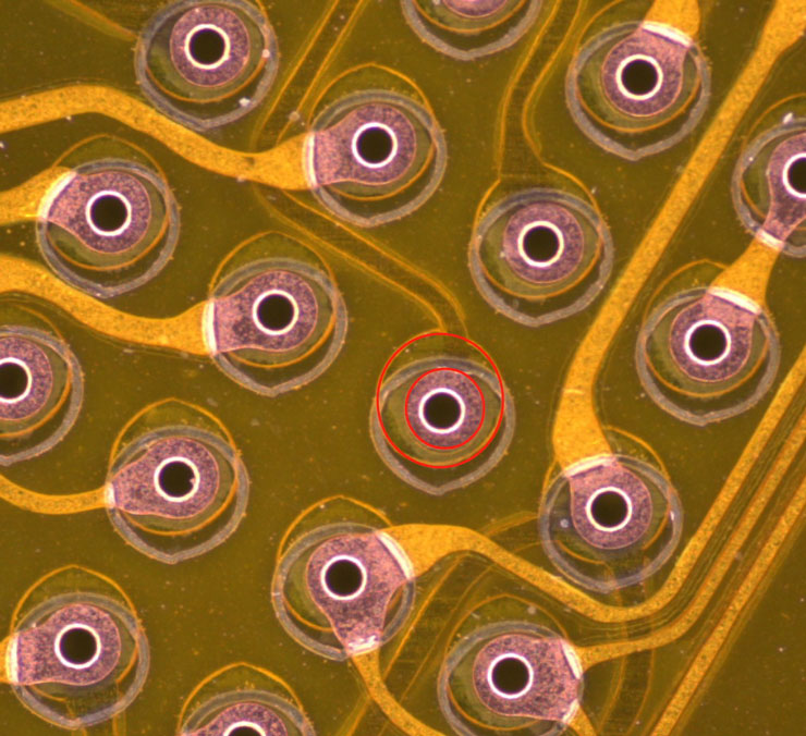 笼罩膜偏位 笼罩膜偏位